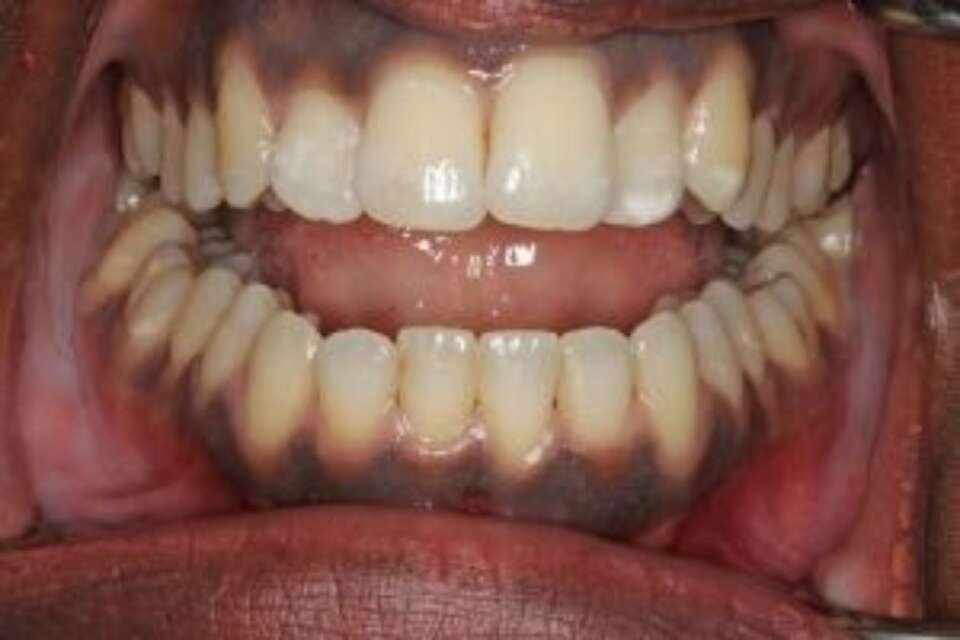straight front teeth
