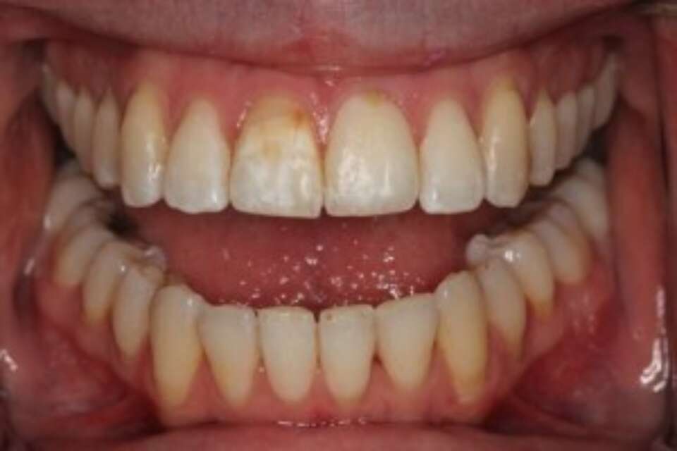 Straight teeth in a matter of months