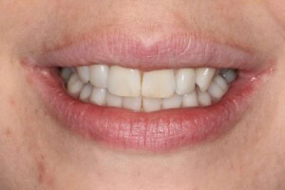 Teeth aligned perfectly straight