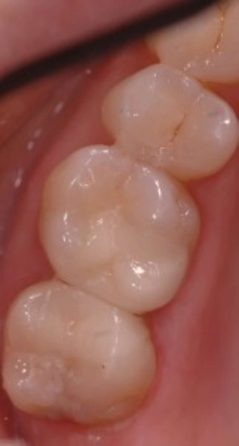 tooth with white filling