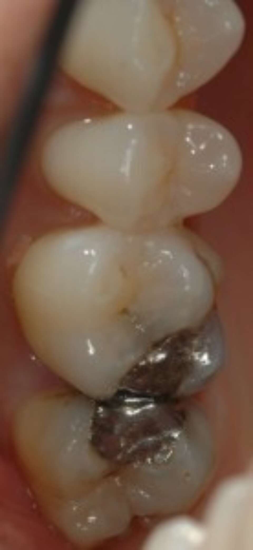 tooth with metal filling