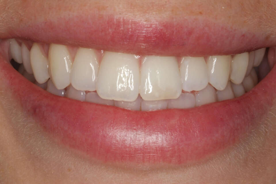 discolouration of left central incisor disappeared