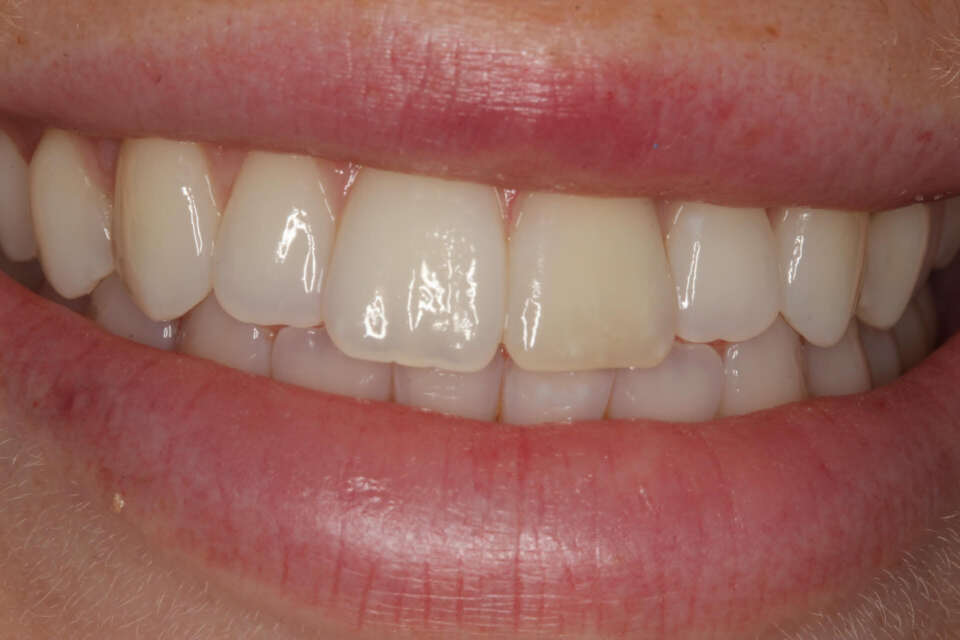 discolouration of left central incisor