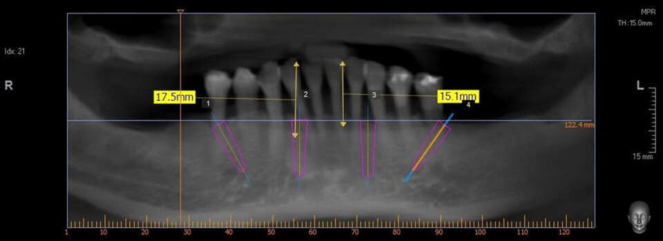 Virtual implant planning