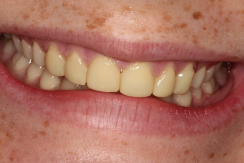 Discoloured composite veneers on upper front 6 teeth