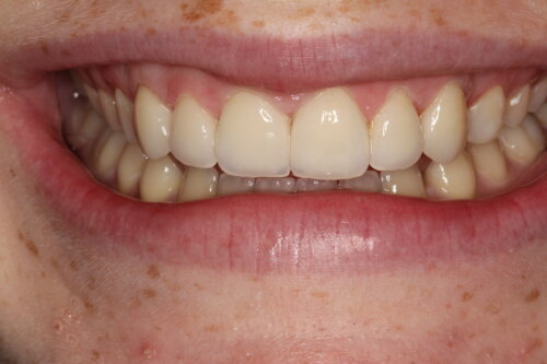 Translucency light reflection on porcelain veneers