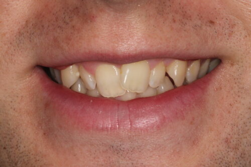 Heavily twisted lateral incisors as central teeth overlapping the canine teeth sticking out