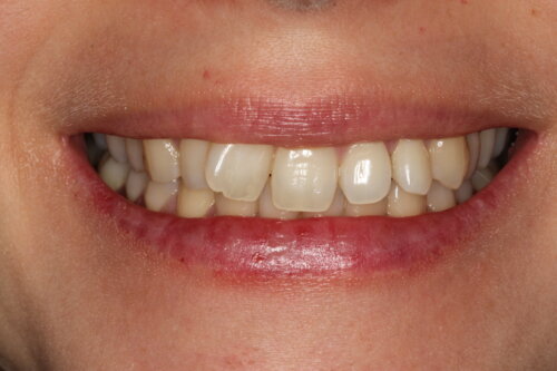Severely rotated front tooth