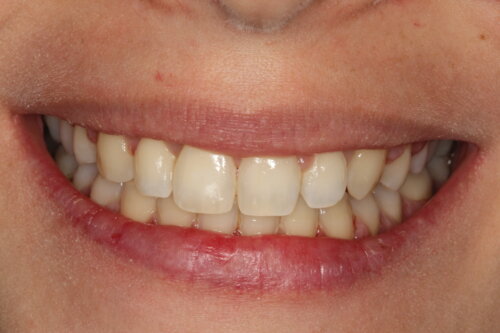 Smile transformed with invisalign treatment