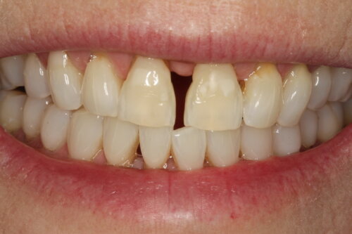 Large space between the front teeth increased over time through gum disease