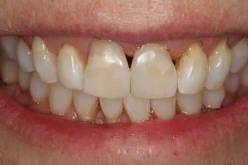 Composite bonding used to close the space between front teeth