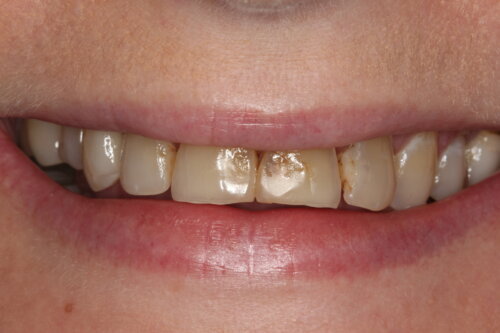Worn discoloured front teeth
