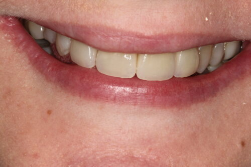 Natural aesthetic long lasting teeth using e max veneers