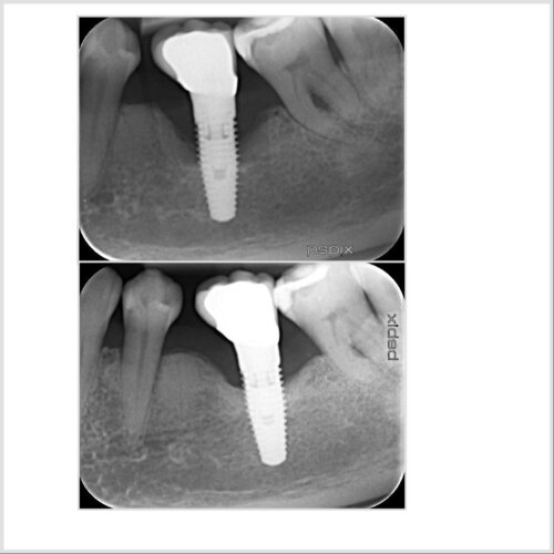 Bone regeneration is clear to see the dental implant is now stable with a good long term prognosis