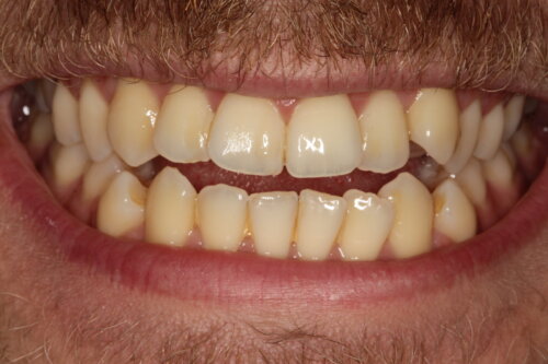 Narrow arches associated with a buccal corridor where the back teeth cannot be seen on smiling