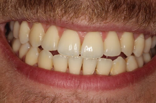 Wider more symmetrical smile closure of the open bite