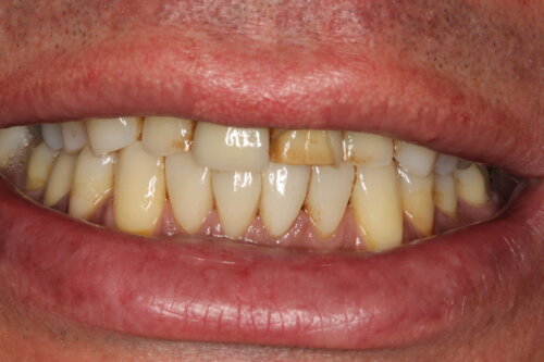 Before treatment replace failing veneers place veneers on adjacent teeth for symmetry