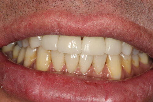 After treatment great improvement with an even natural fuller smile