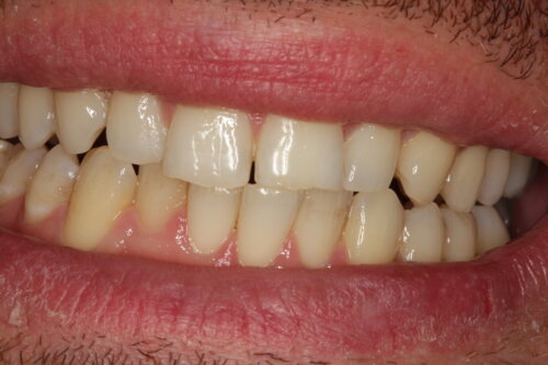 Mouth before invisalign comprehensive treatment has classic tooth crowding uneven levels narrow arches worn teeth