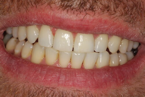 Wide smile after invisalign comprehensive treatment