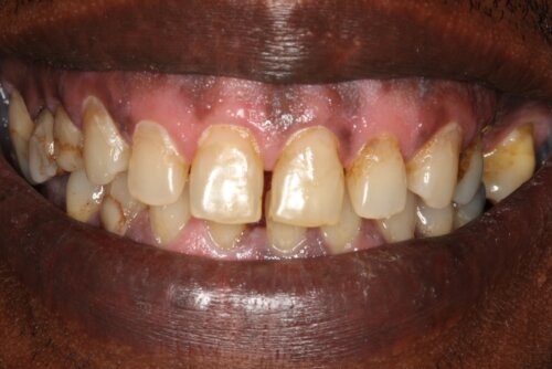 Yellow stained teeth before dental treatment