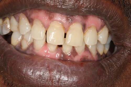 Much whiter brighter teeth after treatment