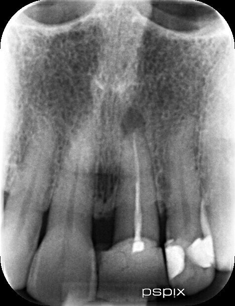 Root canal infection in front tooth