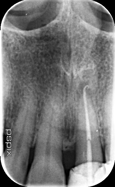 Replacement root treatment