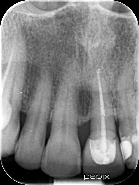 Infection fully healed new crown in place