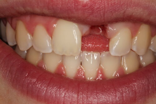 Adhesive Bridge Pre