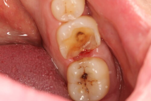 Badly damaged molar tooth which has lost some cusps
