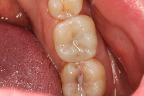 Porcelain onlay placed to restore the tooth