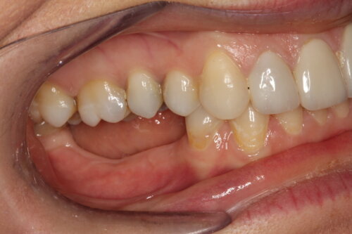 Most of the teeth on the lower right side missing