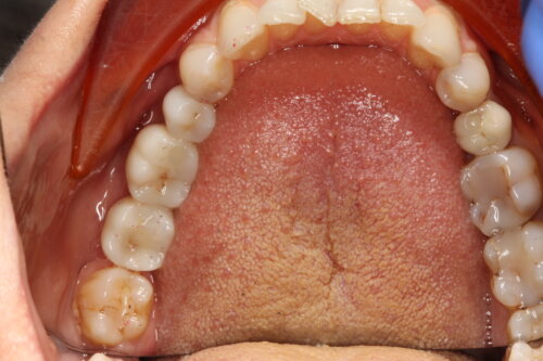 Birds eye view of full set of teeth including 2 dental implants
