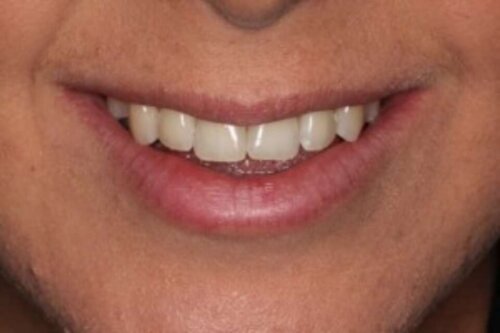 2straight teeth after only twelve weeks 2022 11 01 132518 rfsc