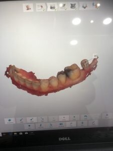 3 D intra oral scan 225x300