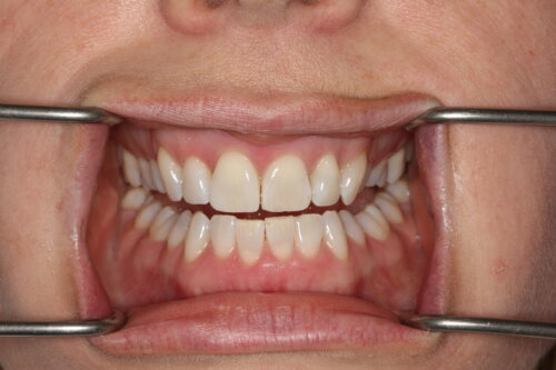 Mouth after hygiene visit