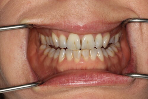 Mouth before hygiene visit