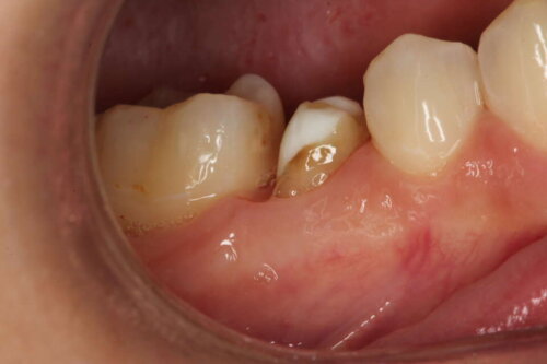 A heavily filled premolar tooth which has a root filling