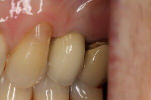 After Dental Implant 300x200 3