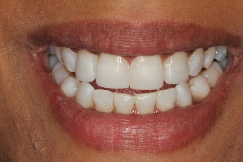 After Invisalign whitening and bonding