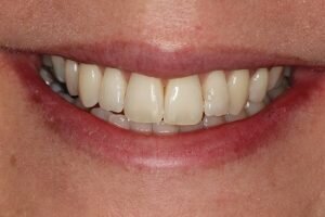 After Social 6 brace 300x200 2