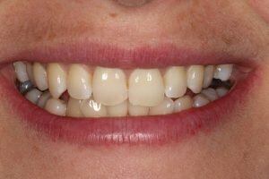 After Social 6 braces 300x200