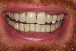 After Social 6 lingual braces 300x200 7