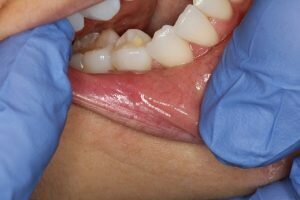 After Waterlase laser removal of polyp 300x200