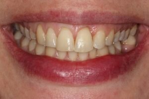 After braces 300x200 2