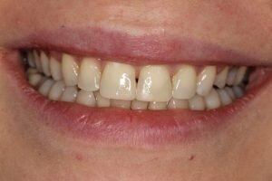 After ceramic braces 300x200 9