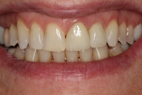 After ceramic crowns