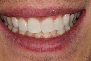 After cosmetic bonding 300x200 1