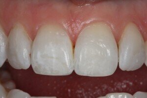 After cosmetic bonding 300x200aa